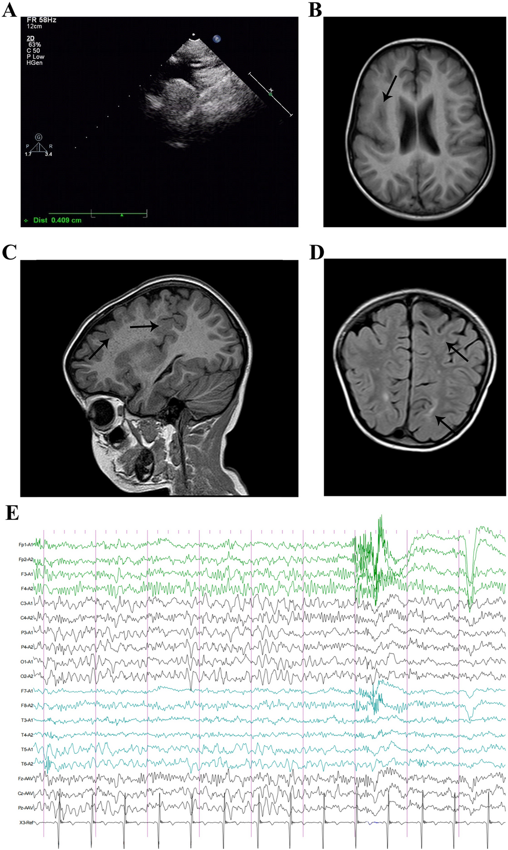 Aberrant RNA splicing caused by variant in  identified in a patient with pharmacoresistant epilepsy