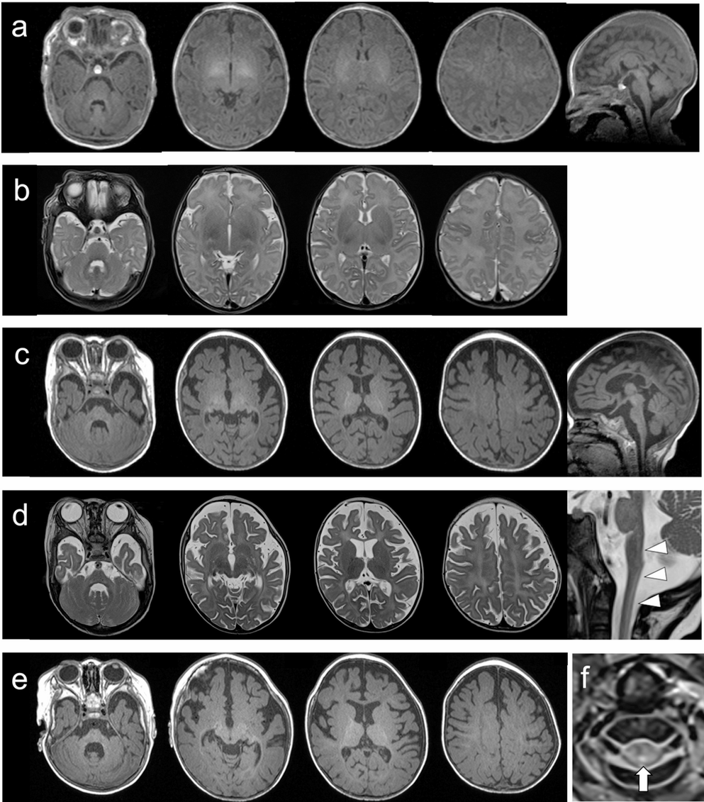 -related hypomyelinating leukoencephalopathy presenting with congenital bilateral vocal cord paralysis and a spinal cord lesion