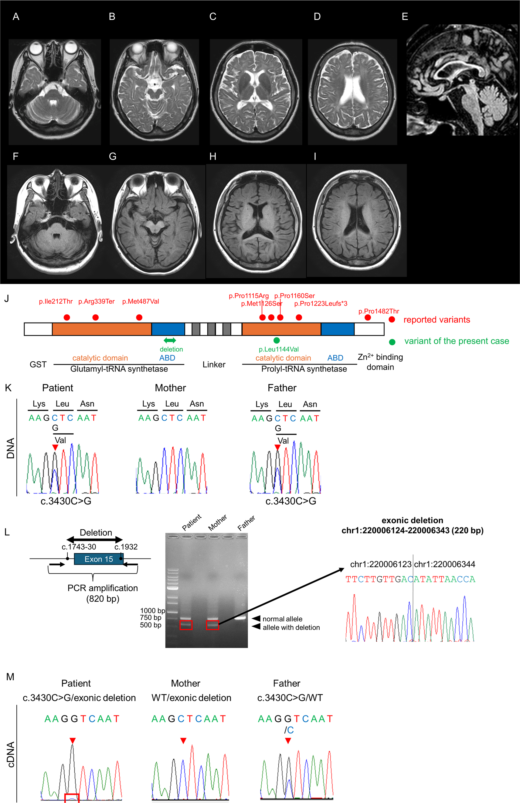 Compound heterozygosity of a novel missense variant and exonic deletion in hypomyelinating leukodystrophy 15