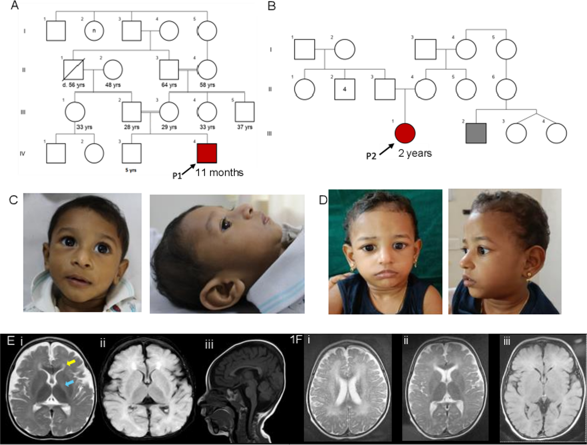 A novel homozygous in-frame deletion variant in  causing Galloway-Mowat syndrome 5