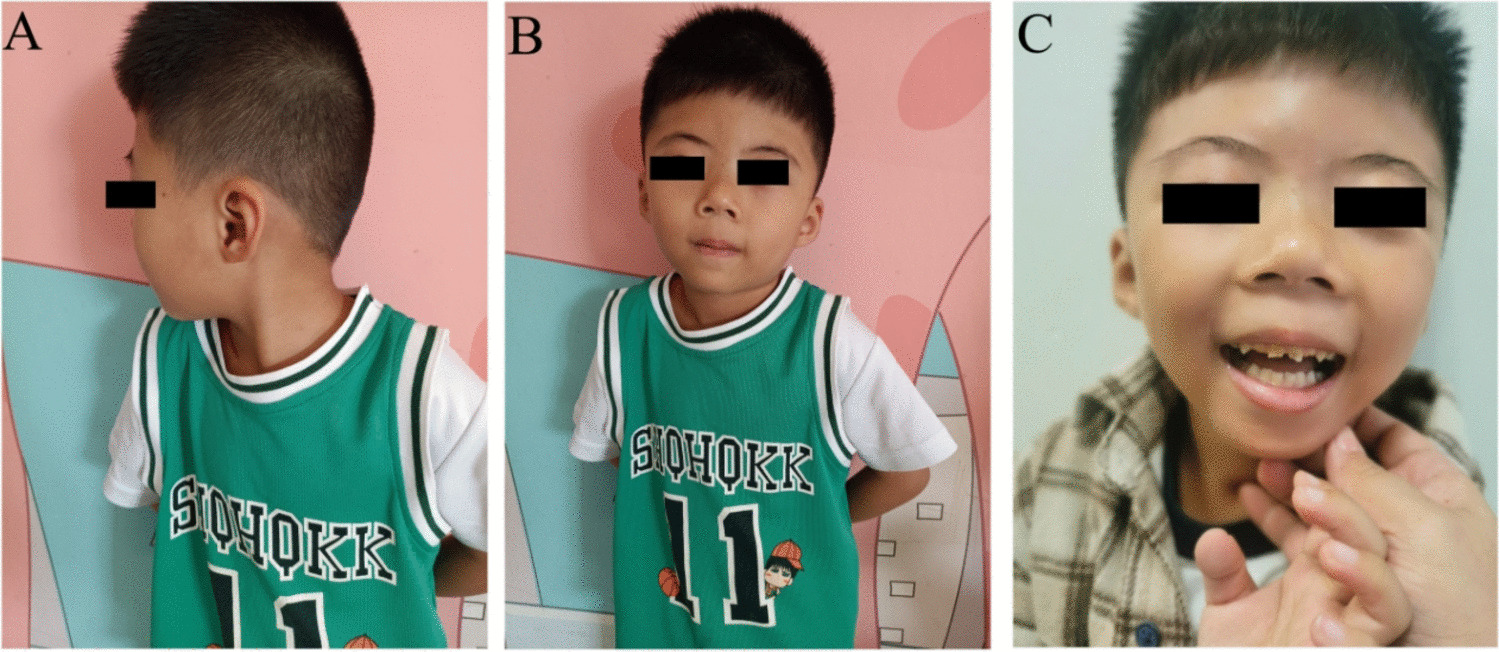 A novel heterozygous mutation of  gene causes neurodevelopmental disorder and middle type hypospadias in a Chinese boy with 5 years follow-up