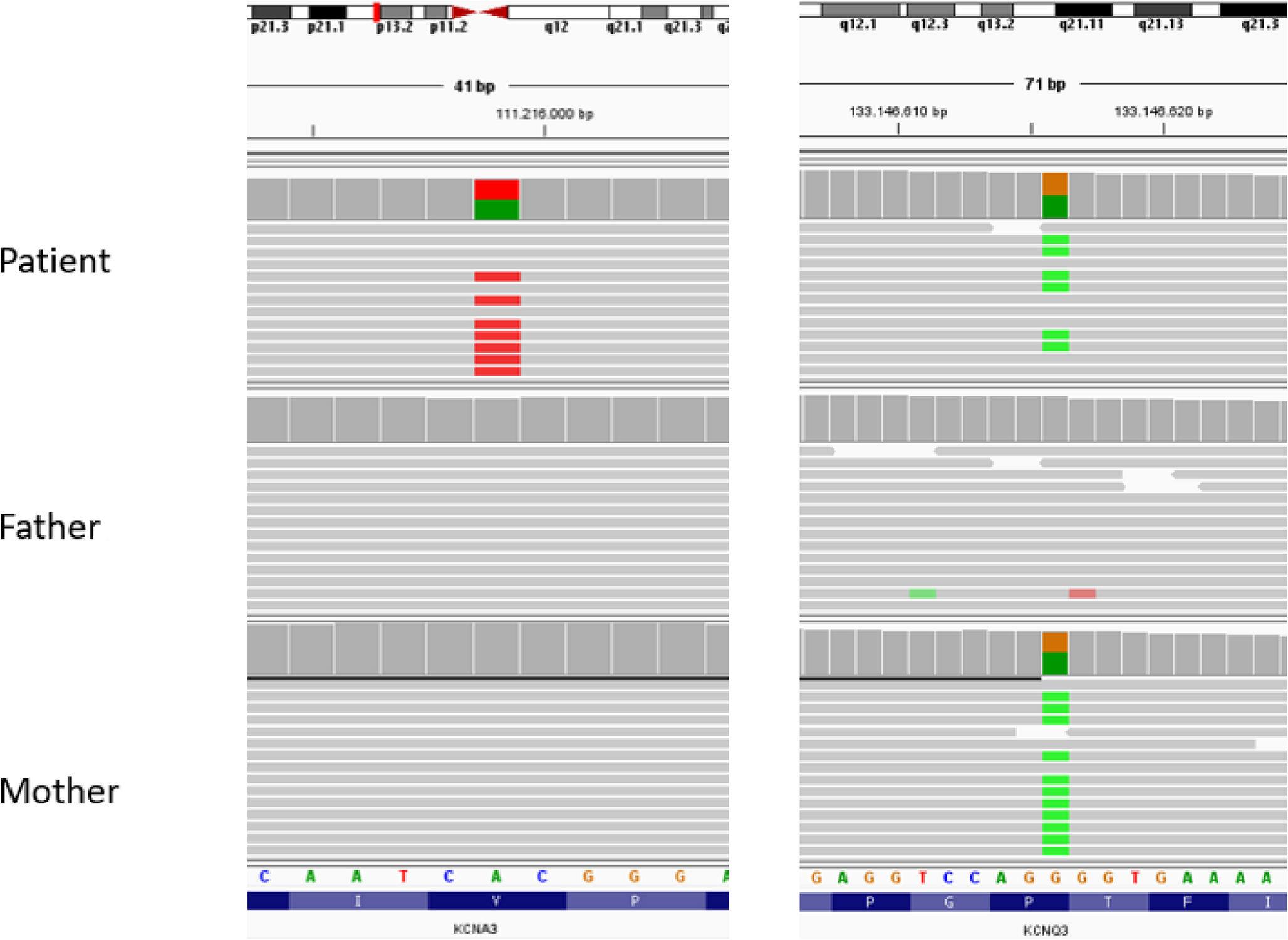 A  and an inherited  missense variant causing a developmental and epileptic encephalopathy, intellectual disability, and behavioral anomalies