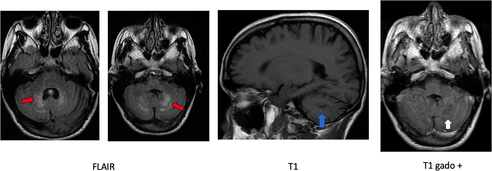Clinical and neuroimaging features in a case of cerebrotendinous xanthomatosis with a  genotype newly identified in morocco: a literature review of African cases