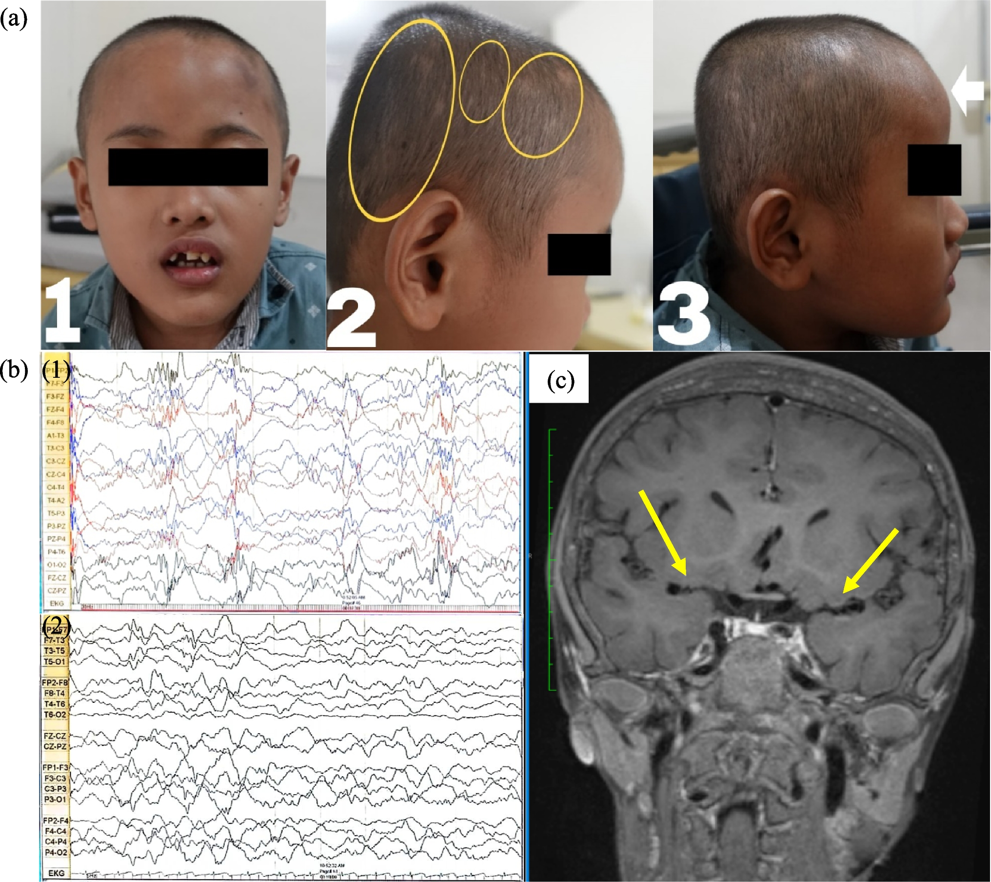 ADK deficiency without hypermethioninemia presenting as intractable epilepsy: a rare neurometabolic case and literature review