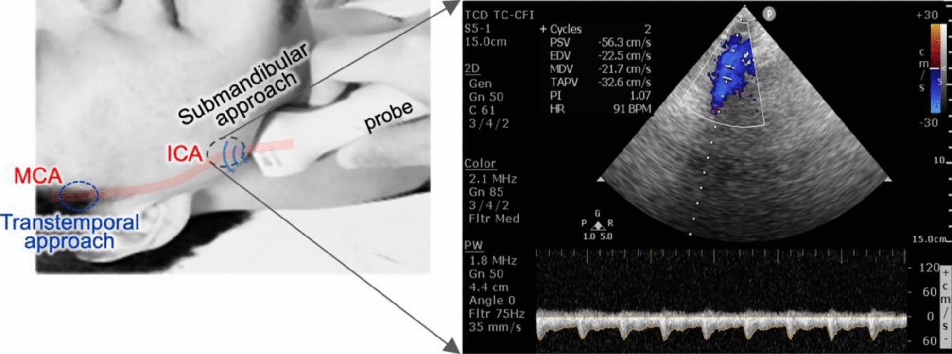Pulsatility Index Measurement via the Submandibular Internal Carotid Artery: An Alternative to Transcranial Assessment