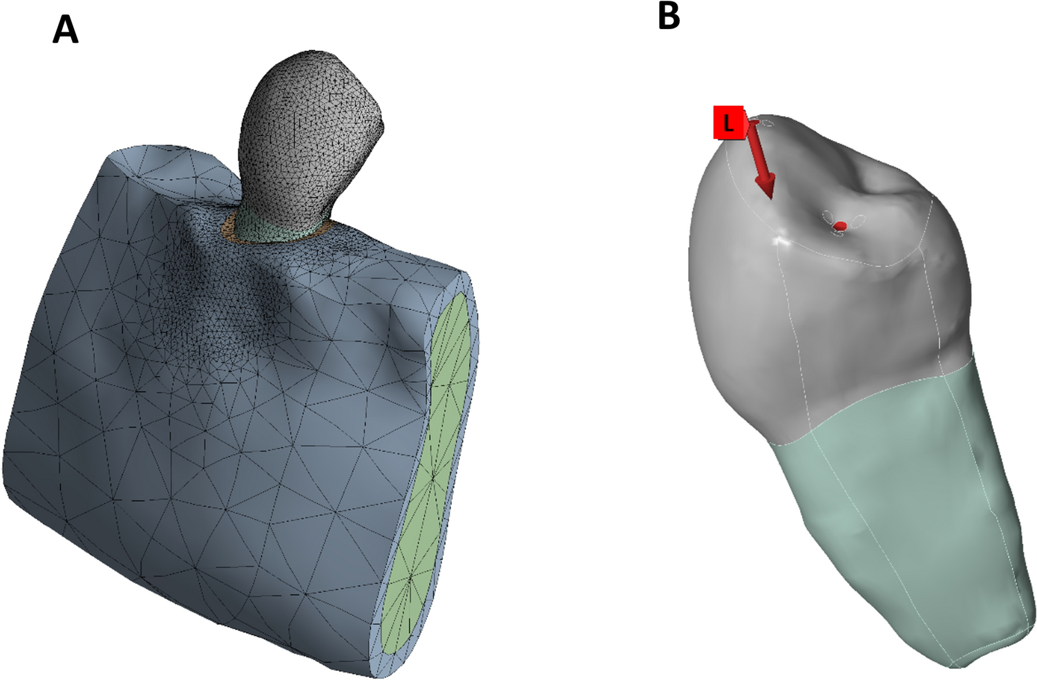 Comparative analysis of postoperative mechanical behavior of immature premolars: apexification vs regeneration