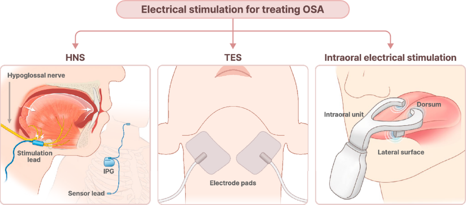 Upper airway muscle activation in obstructive sleep apnea: a brief overview of emerging neuromodulatory and pharmacologic therapies