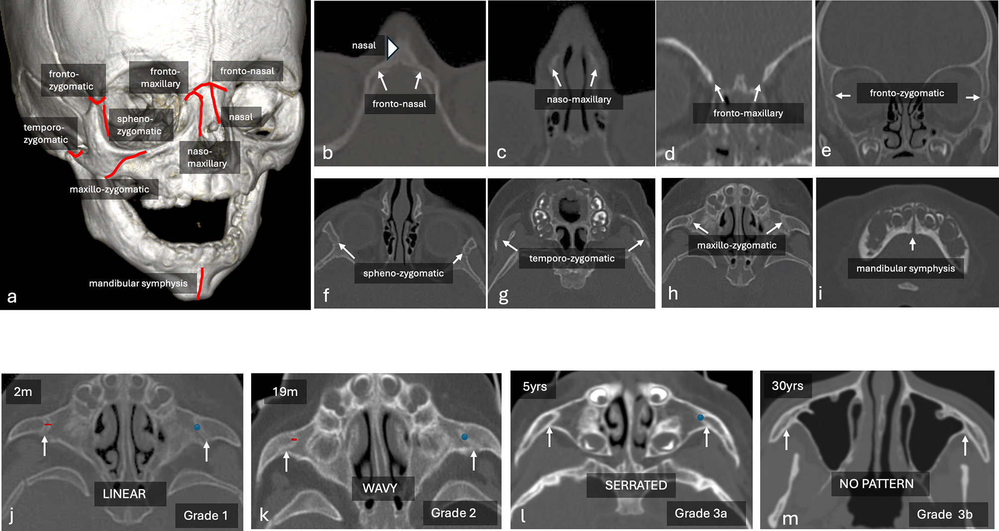Age-related structural changes of the facial skeleton: insights from sutural ossification and CT-based analysis