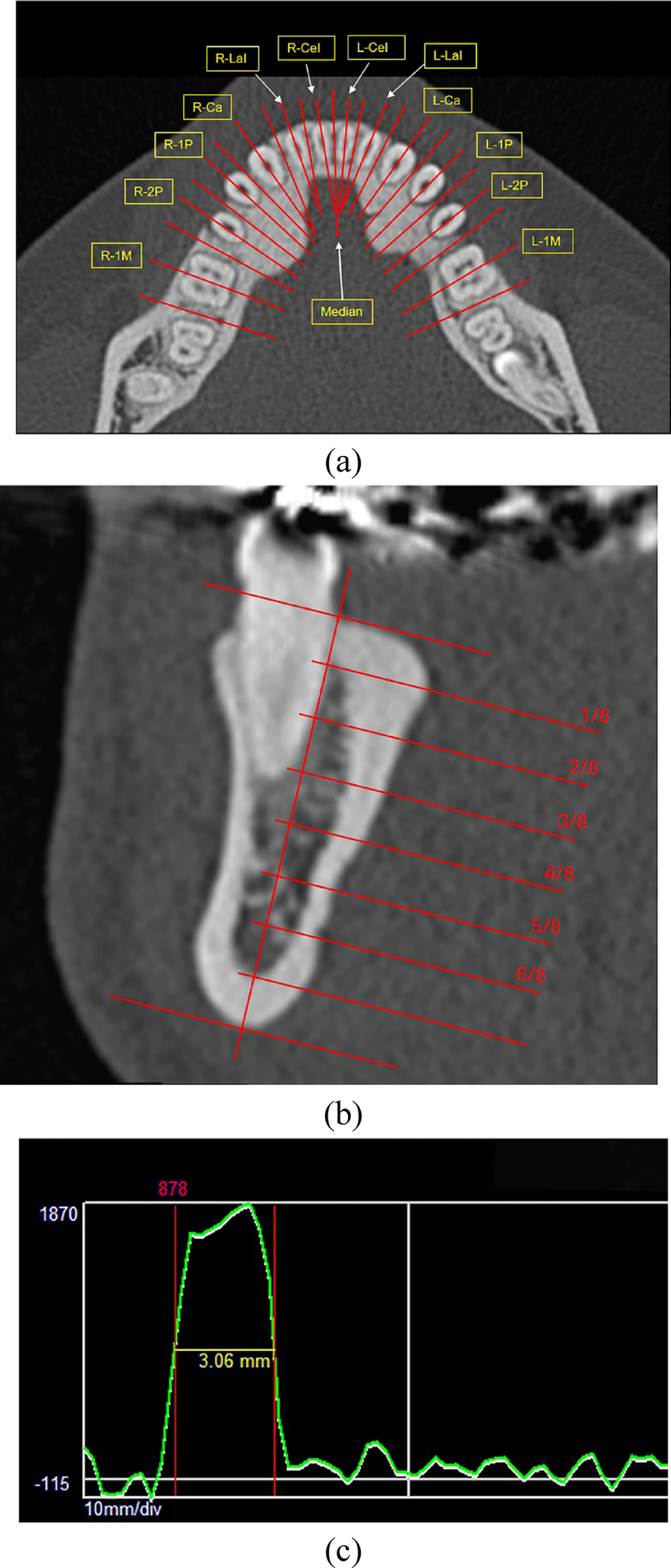 Imaging-based anatomical study of torus mandibularis: morphological features identified by computed tomography and their correlation with panoramic radiographic appearances
