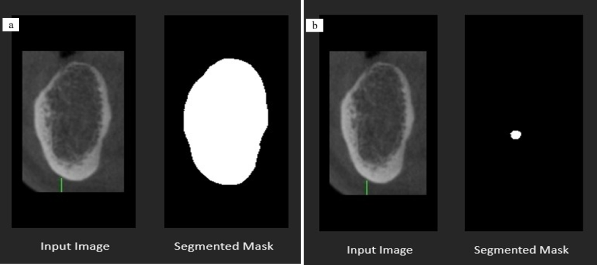 Comparison of artificial intelligence methods with manual measurements for mandibular bucco-lingual bone width assessment using cone-beam computed tomography images