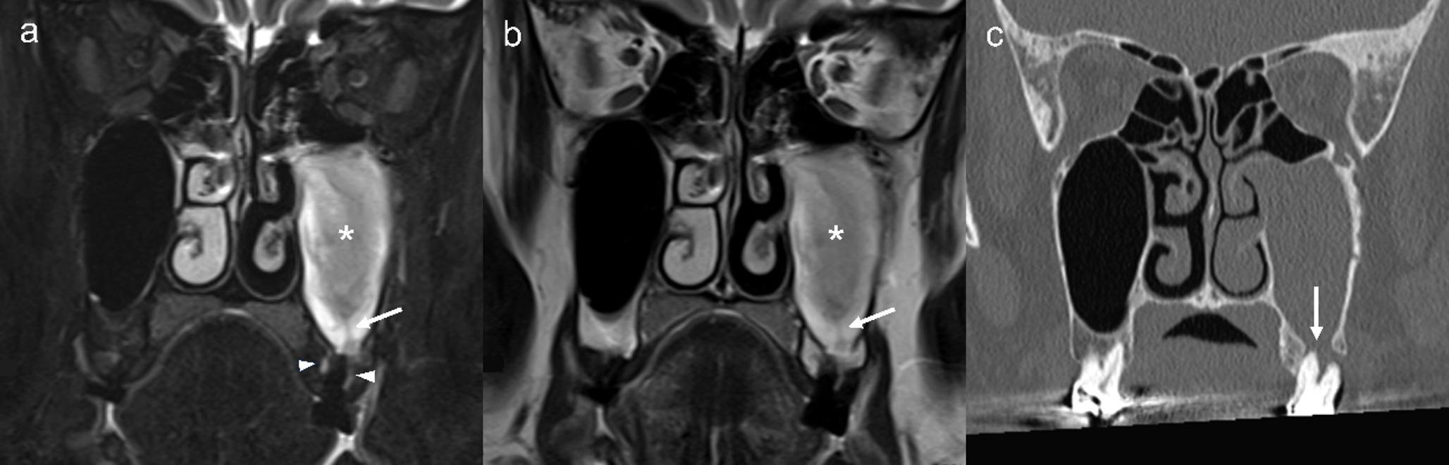 Diagnostic value of rising smoke sign on MRI: a characteristic finding of odontogenic maxillary sinusitis