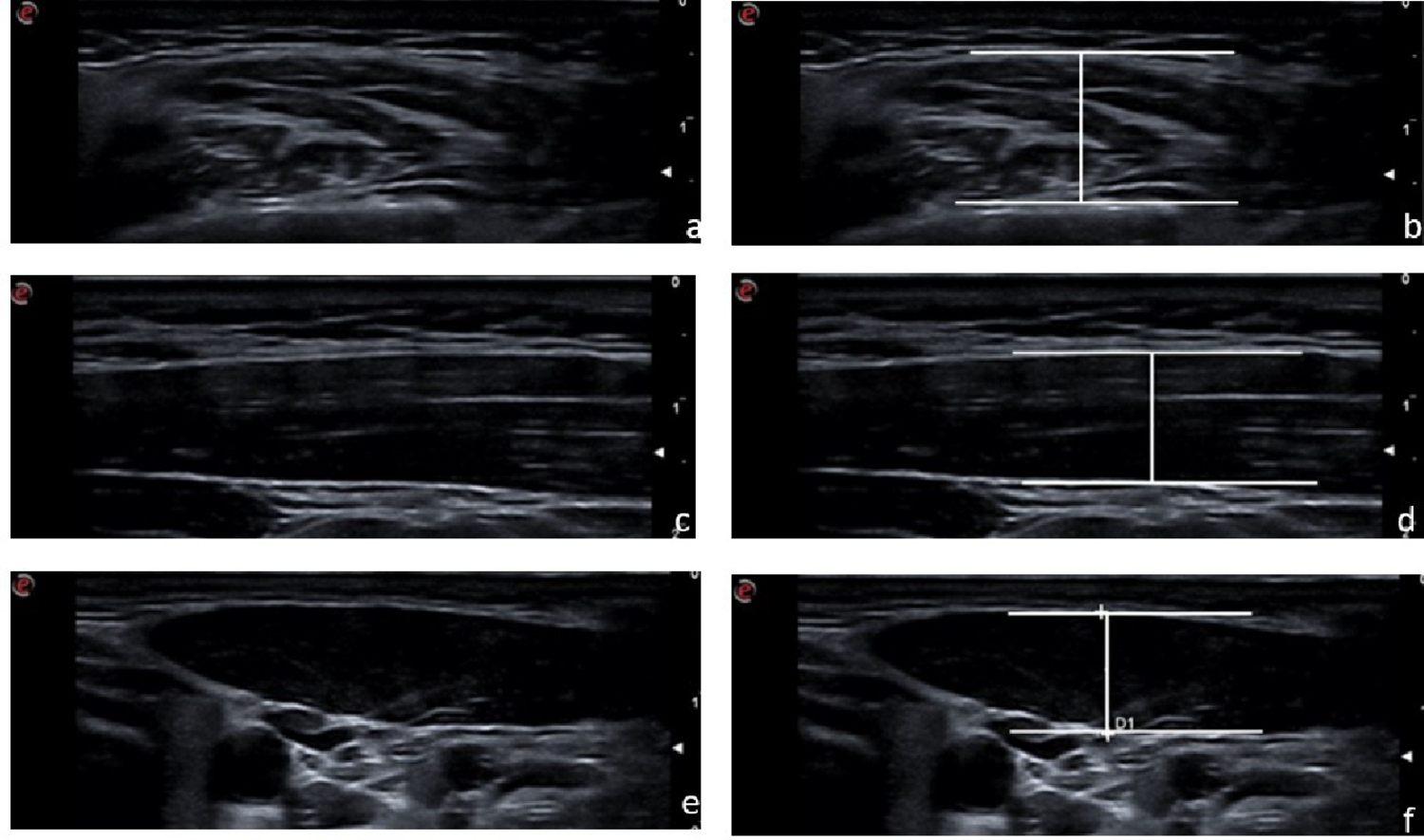 Ultrasonographic evaluation of masseter, trapezius, and sternocleidomastoid muscles in patients with internal derangement in the temporomandibular joint