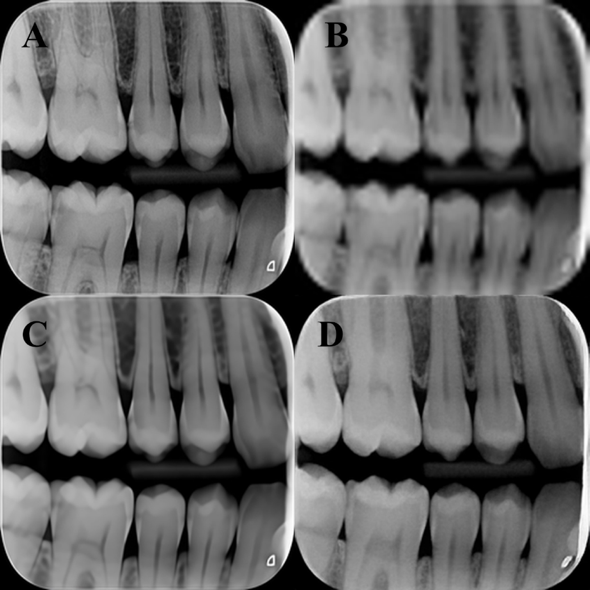 Enhancing diagnostic quality in dental bitewings using transformer and GAN-Based image restoration