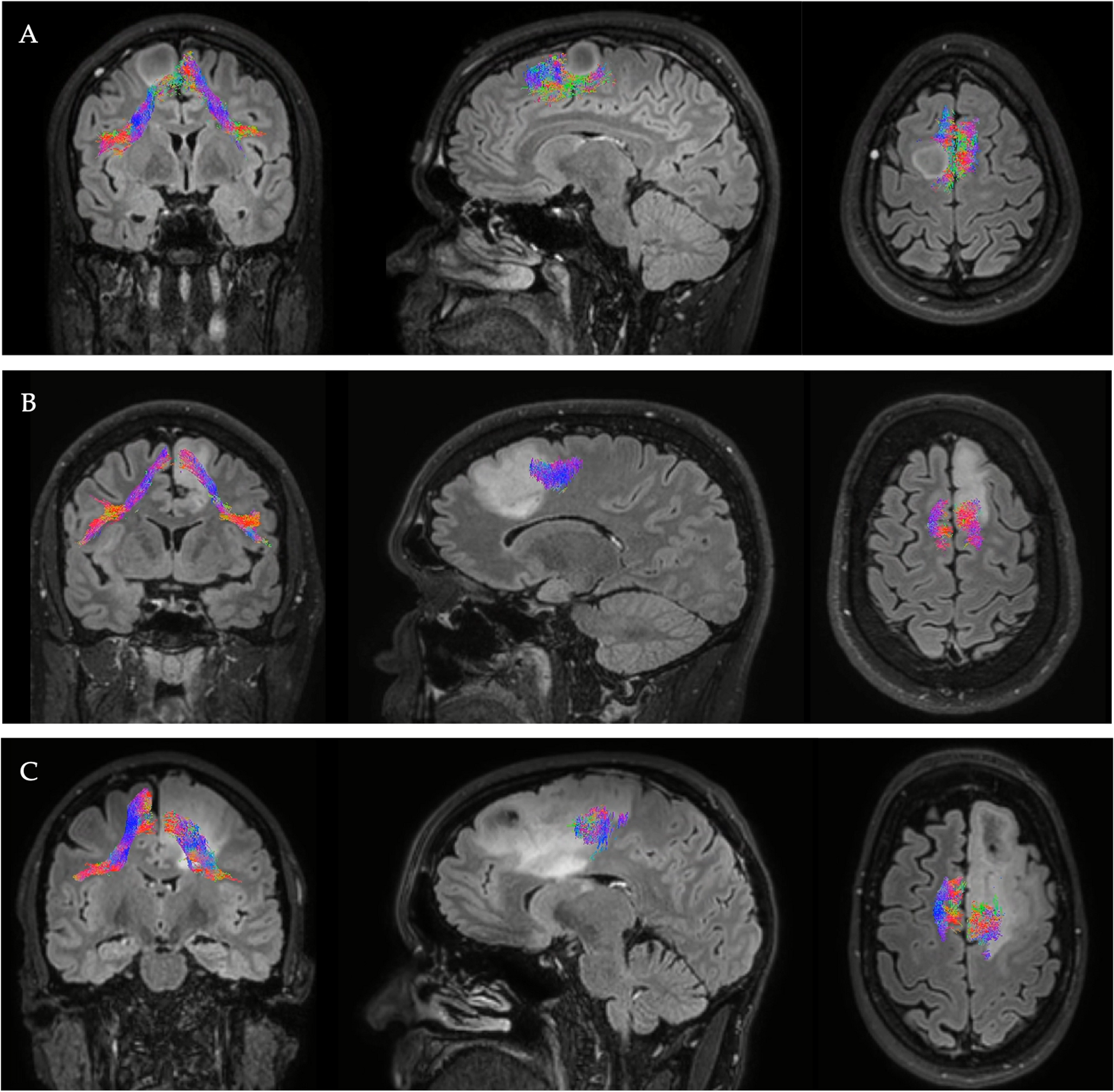 Objective characterization of displacement of the frontal aslant tract in low-grade glioma: a quantitative tractography study