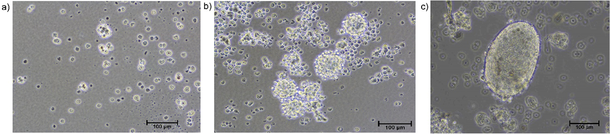 Patient-derived spheroid culture: A promising in vitro model for drug screening in retinoblastoma