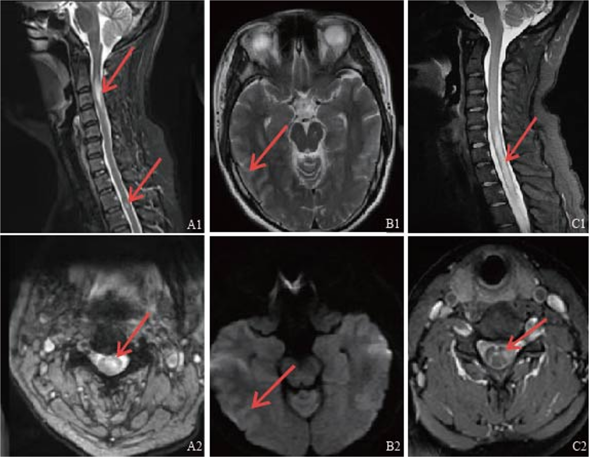 Successful treatment with efgartigimod as rescue therapy in acute attack of MOGAD: a case report