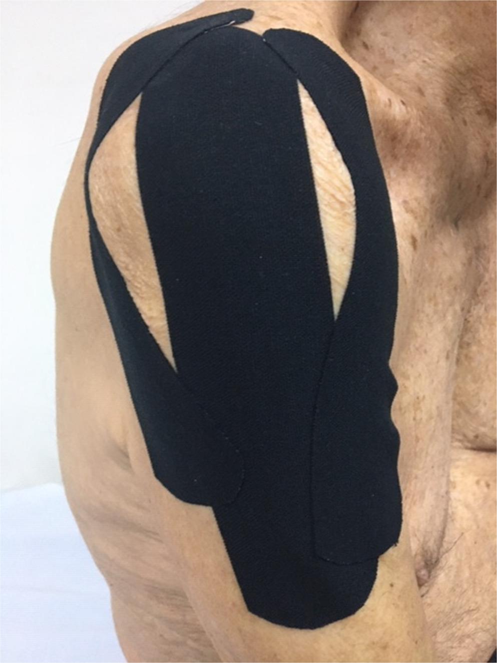 Effectiveness of combined physical therapy and kinesio tape for acute hemiplegic shoulder pain: a retrospective study