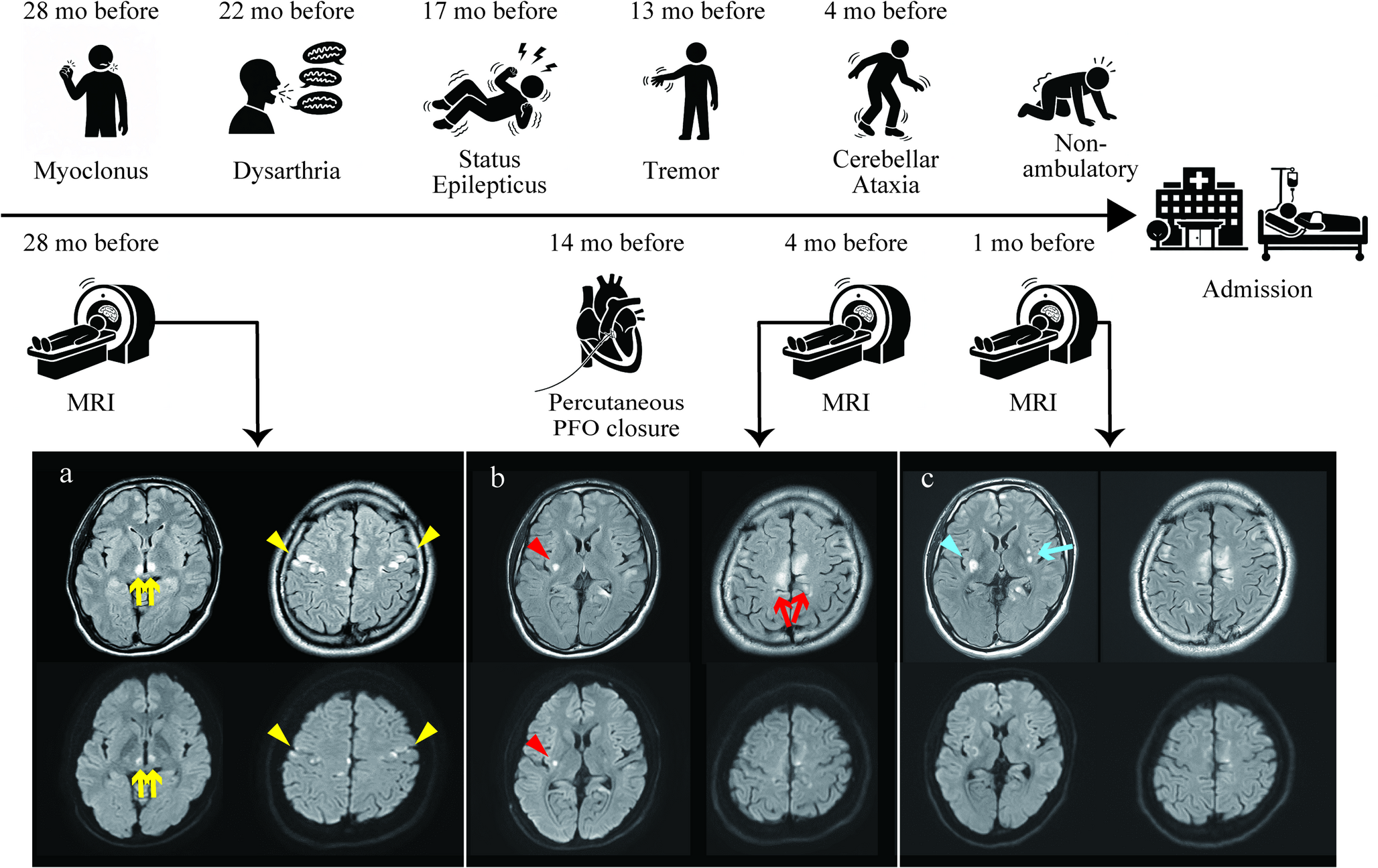 MERRF/MELAS overlap syndrome mimicking paradoxical cerebral embolism due to patent foramen ovale