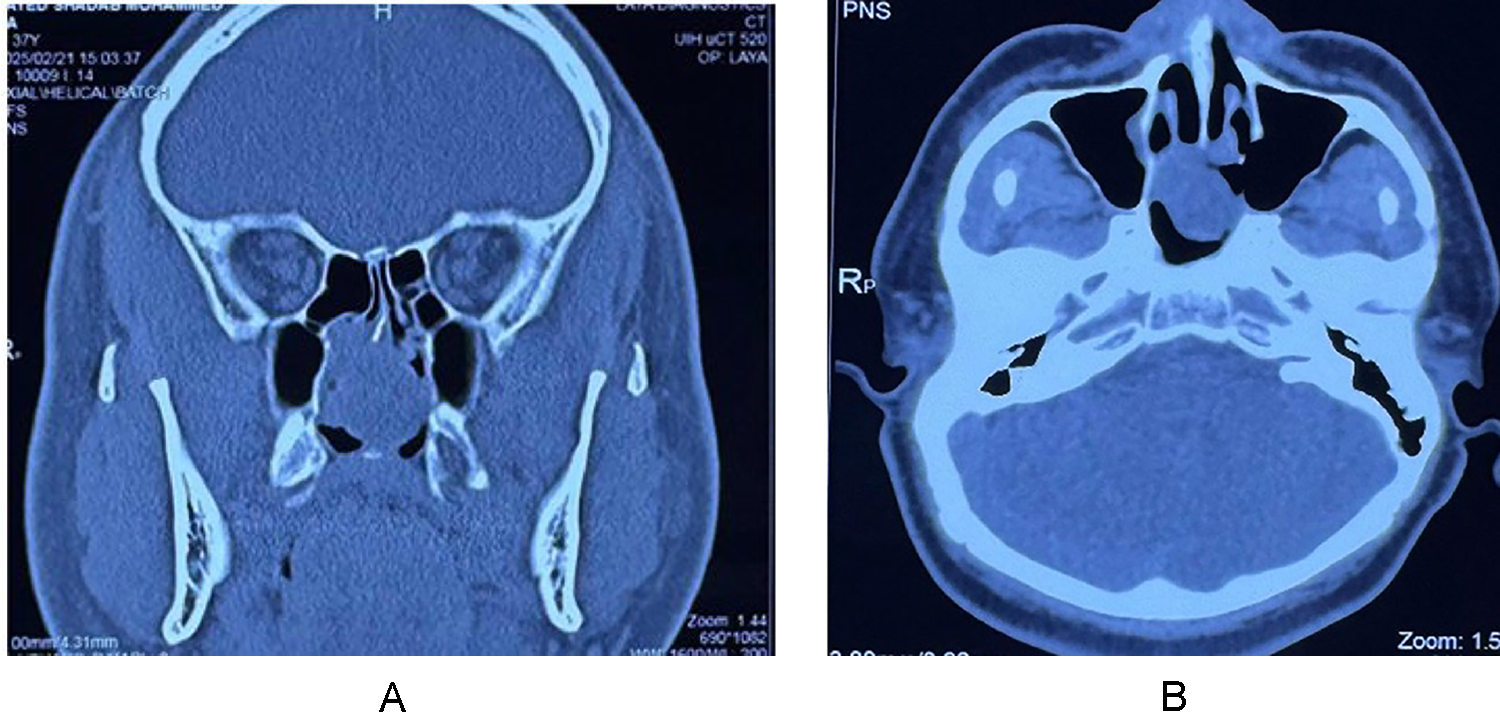 Correction: Sinonasal Clear Cell Carcinoma Masquerading as Recurrent Inverted Papilloma