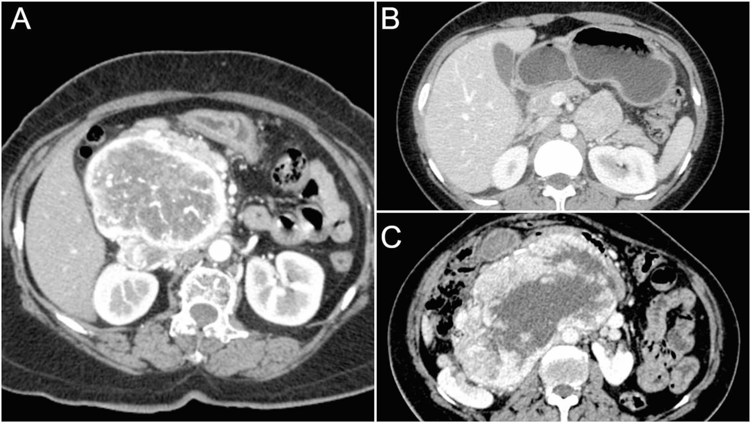Outcomes of Surgical Management of Retroperitoneal Paragangliomas: A Single Centre Experience