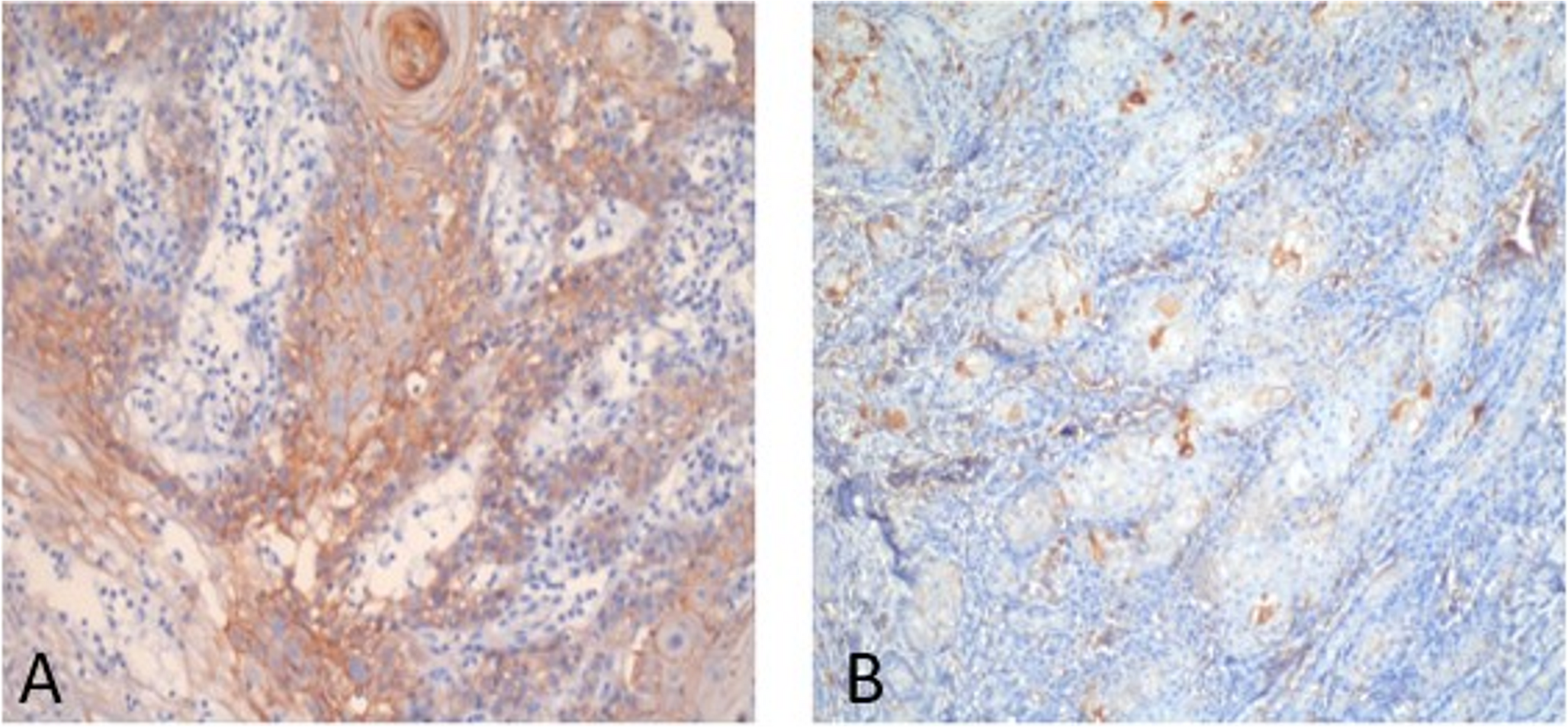 Unveiling the Role of Epithelial-Mesenchymal Transition Markers in Oral Squamous Cell Carcinoma: An Observational Study