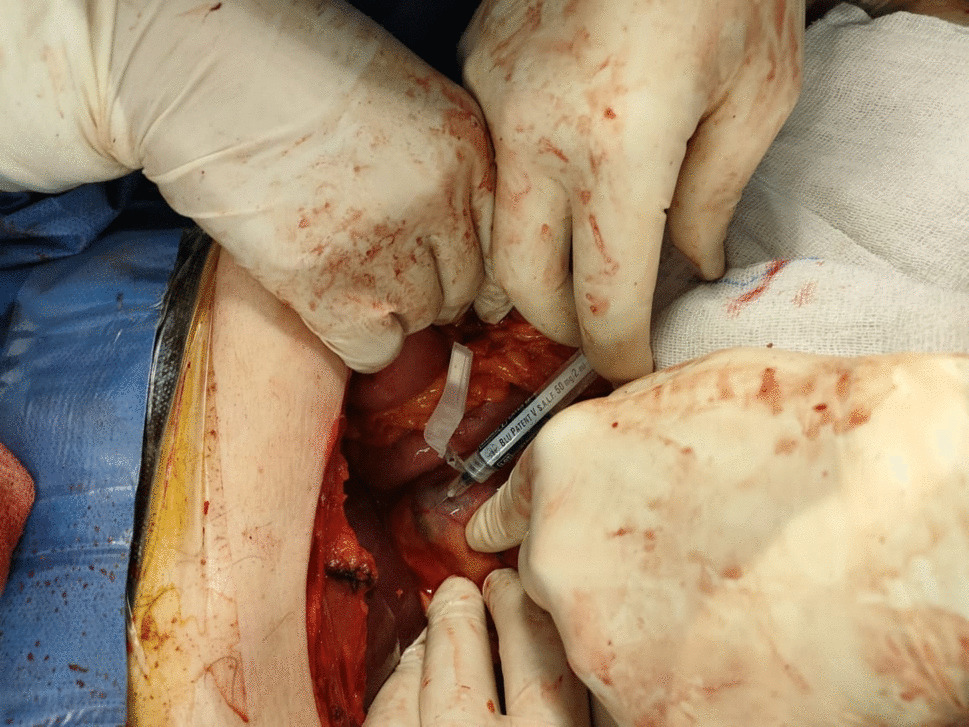 Assessment of the Value of Sentinel Lymph Node in Stomach Cancer Patients Using Blue Dye in Suez Canal University Hospital