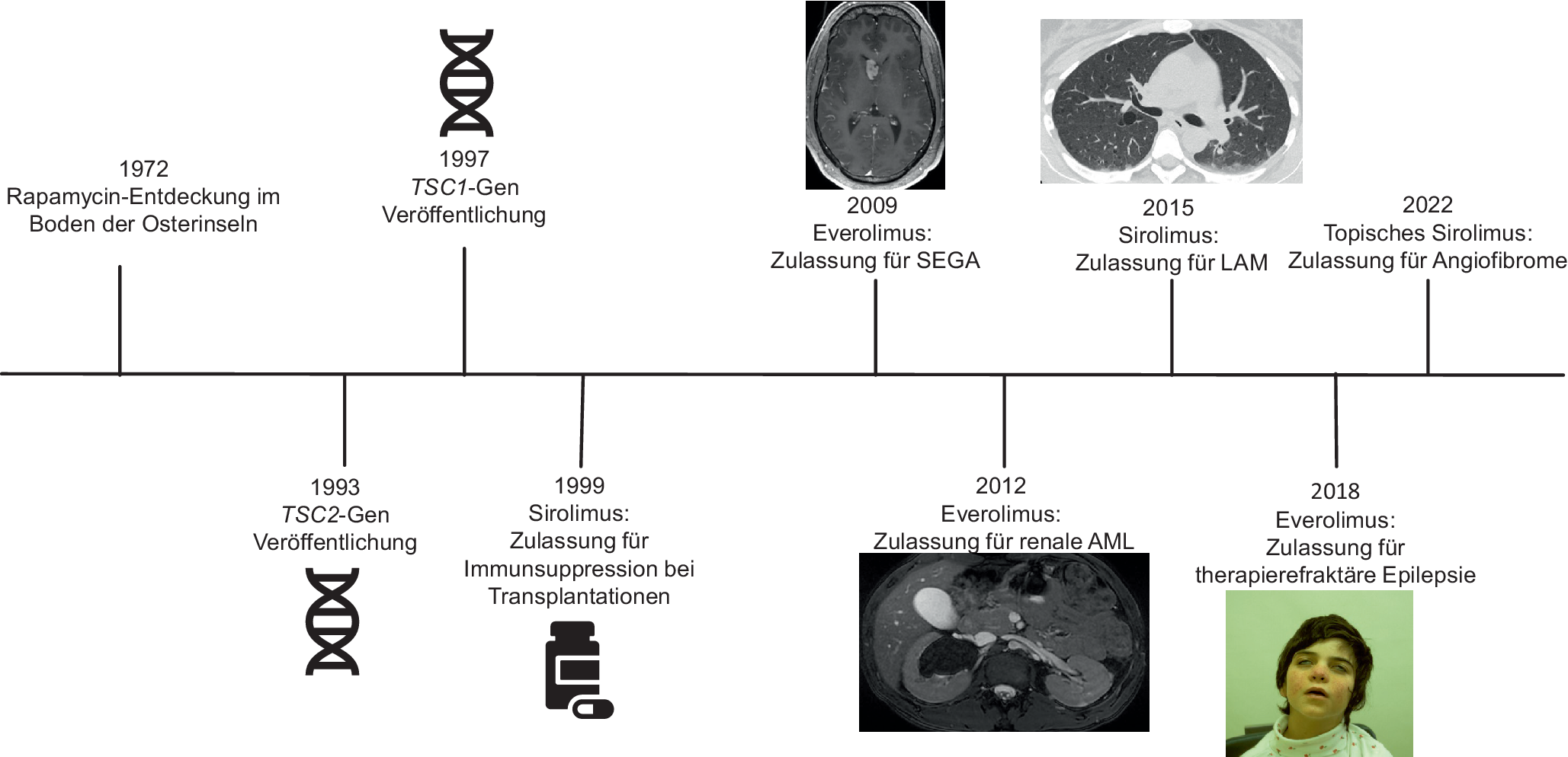 Tuberöse Sklerose-Komplex: Präzisionstherapie mit mTOR-Inhibitoren