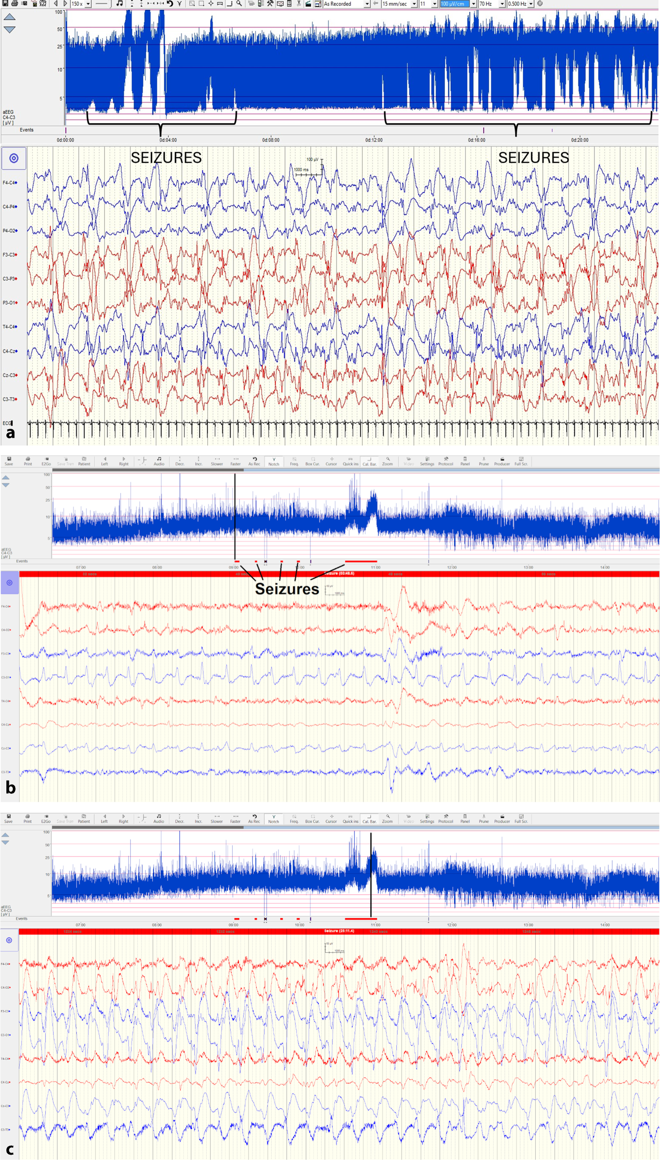 Neonatal seizure detection: a review of current methods, challenges and future directions