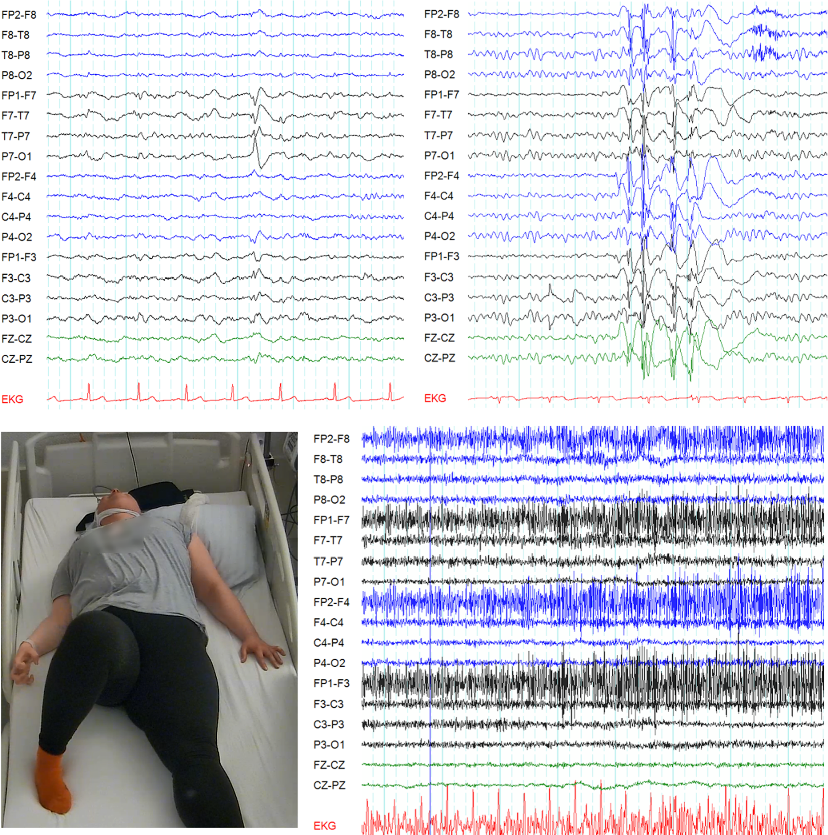 Des Pudels Kern: Differenzierung epileptischer Anfälle von nicht-epileptischen Ereignissen