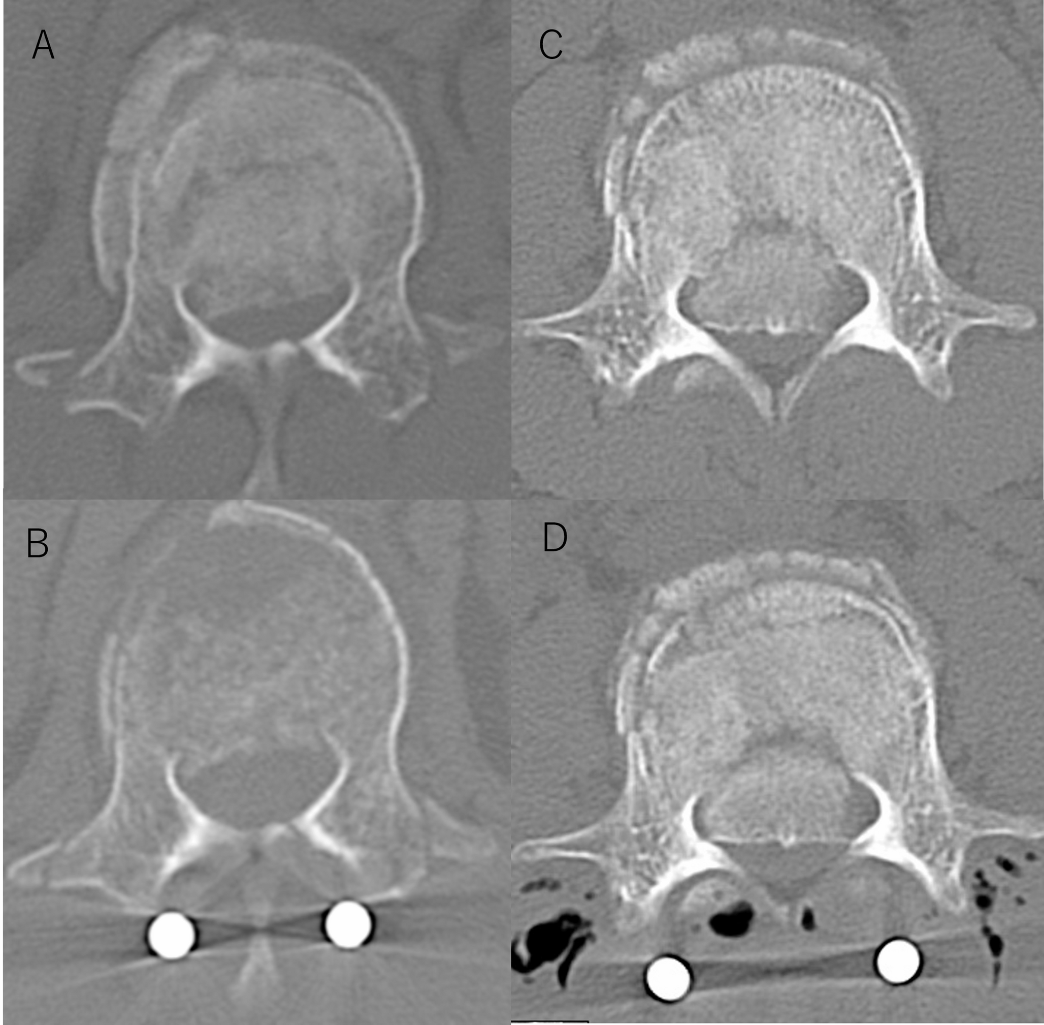 Timing of surgery and predictors of canal reduction after short-segment fixation for thoracolumbar burst fractures