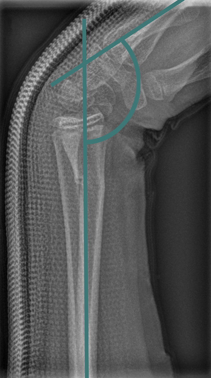Conservative management of 900 pediatric distal radius fractures using the schede cast: a multicenter study
