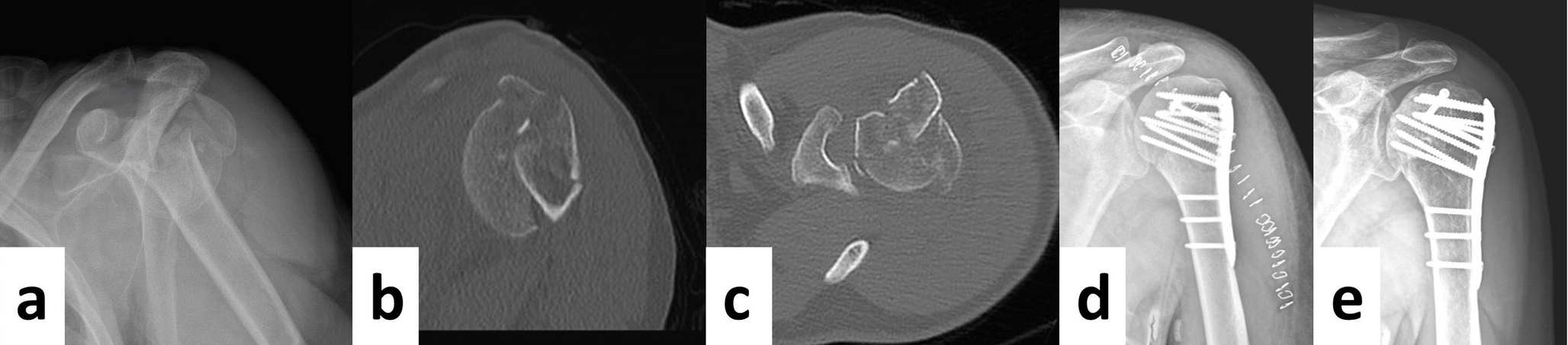 Does the Hertel criteria correlate with postoperative avascular necrosis and failure in proximal humerus fractures? A retrospective cohort study