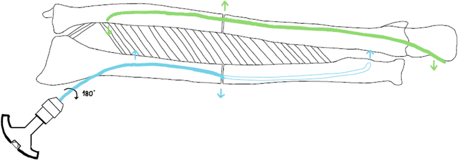 Influence of elastic stable intramedullary nailing on fracture reduction of paediatric diaphyseal forearm fractures