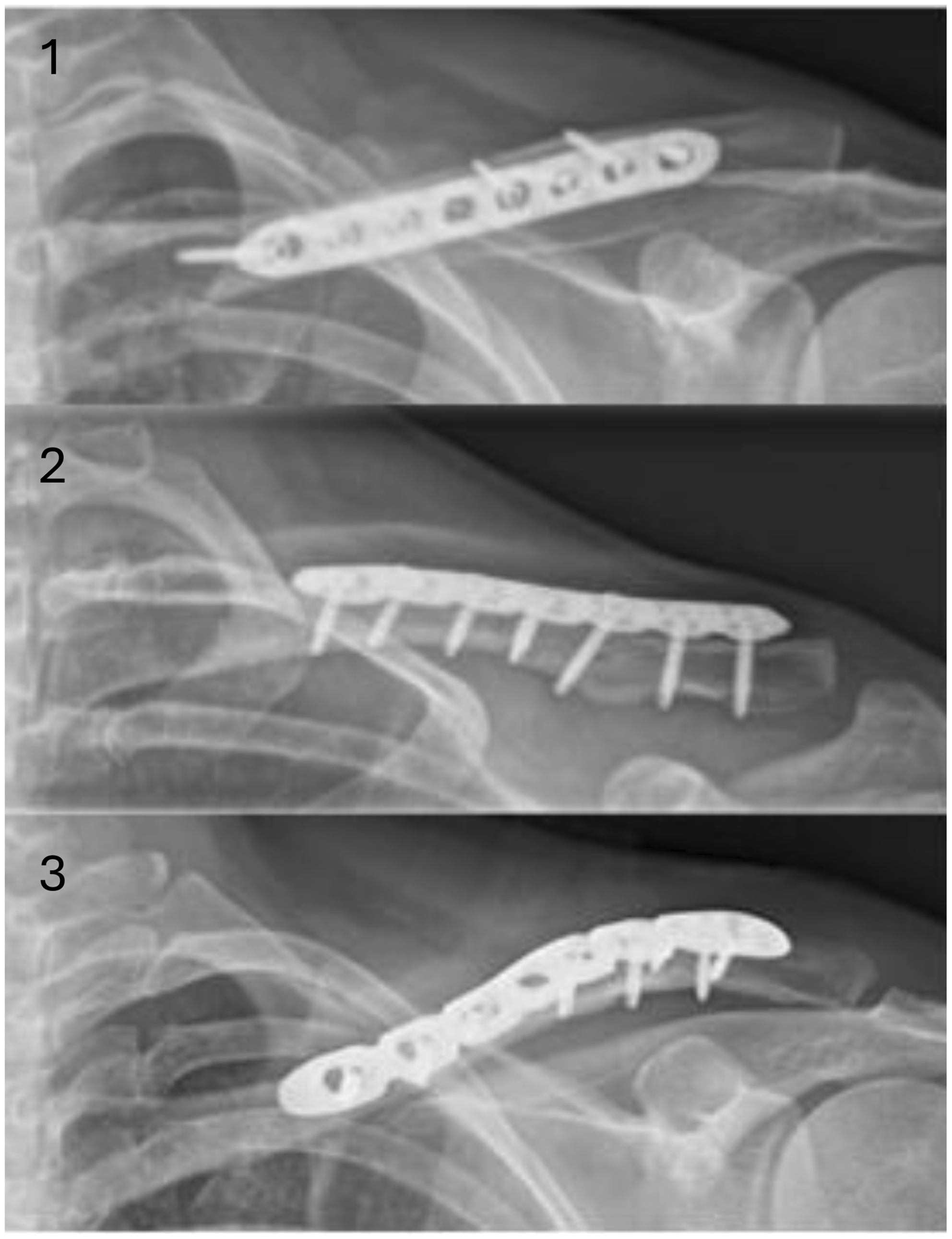 Is there a difference in plate positioning for clavicle shaft fractures? A retrospective cohort study of 355 cases