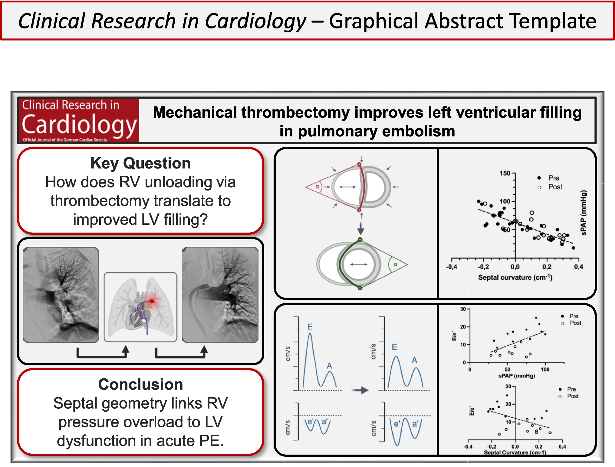 Mechanical thrombectomy improves left ventricular filling in intermediate-high risk pulmonary embolism: the role of ventricular interdependence