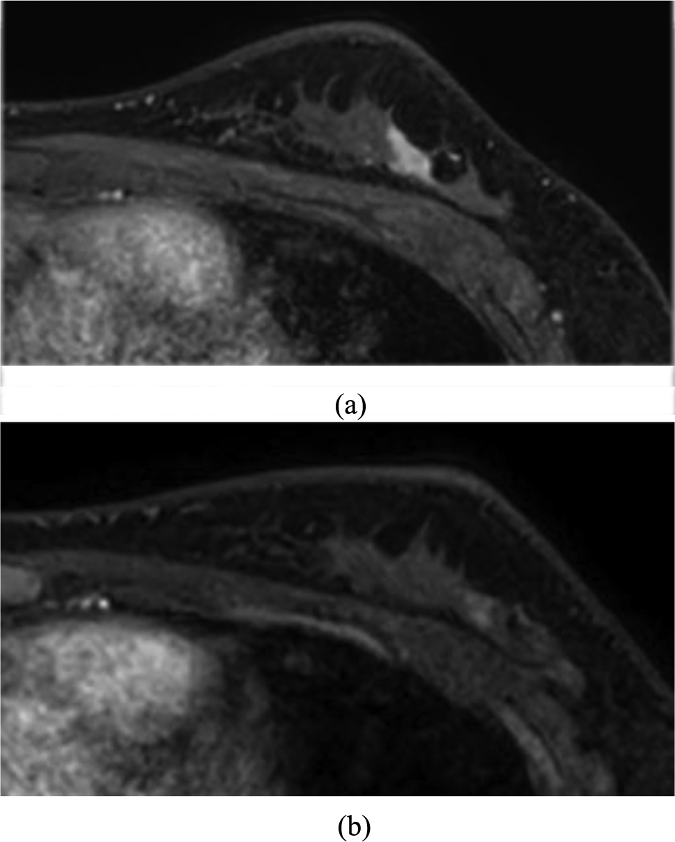 Acinic cell carcinoma of the breast in a patient with a  pathogenic variant: a case report