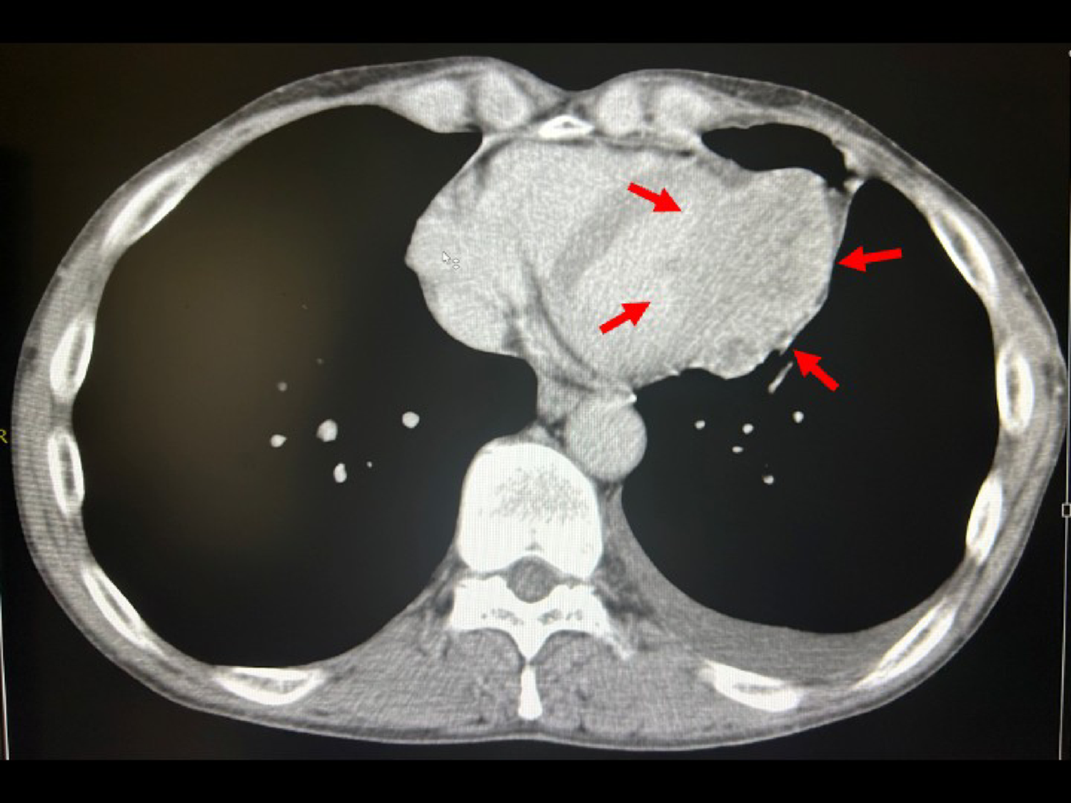 Radiation-induced myocardial metabolic impairment detected by ¹²³I-BMIPP/⁹⁹ᵐTc-MIBI metabolic–perfusion mismatch following thoracic radiotherapy for thymoma: a case report