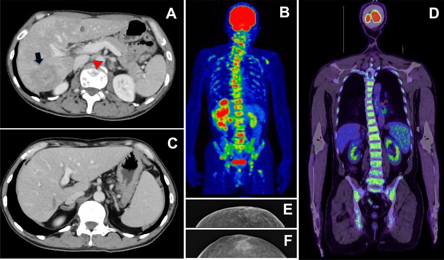 Molecular pathology provides significant insights into the diagnosis and treatment of cancer of unknown primary origin: a case report of an extremely rare male occult breast apocrine cancer