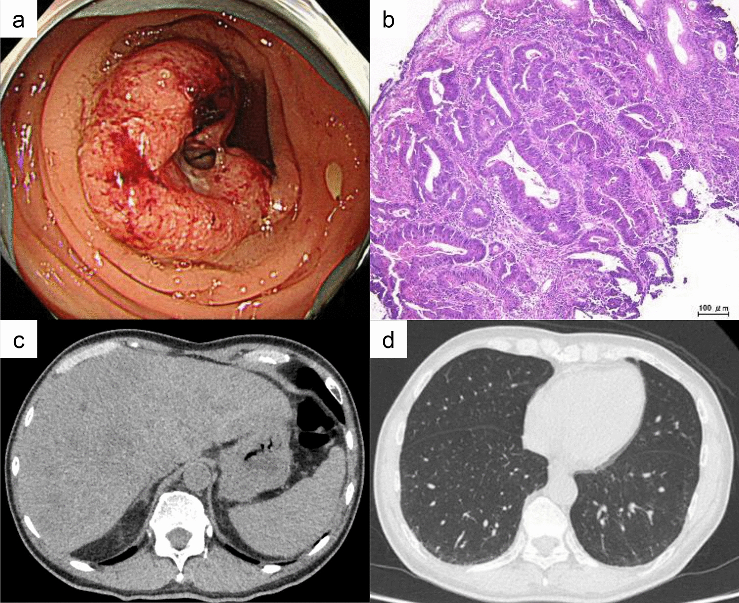 An autopsy case of sigmoid colon cancer with multiple cerebral infarctions associated with drug-induced interstitial lung disease: a case implicating local PAI-1 overexpression
