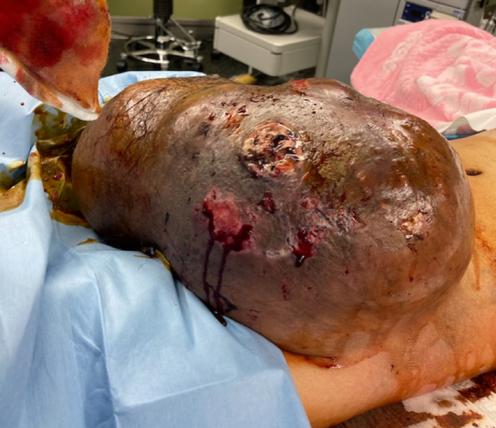 A giant testicular tumor requiring skin valvuloplasty