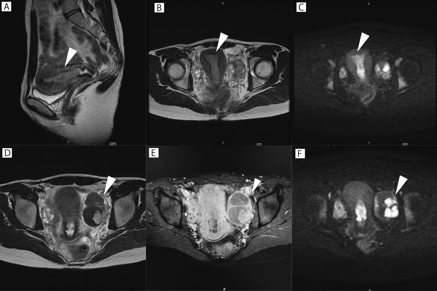 Two successful deliveries following fertility-sparing treatment for synchronous endometrial and ovarian cancer: a case report and literature review