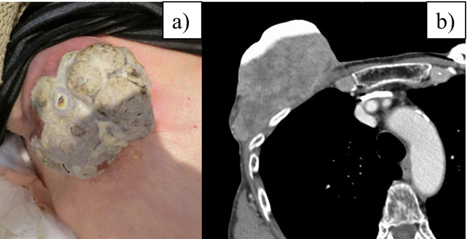 A case of successful combined intensity-modulated radiation therapy and hyperthermia for a large, drug-resistant chest wall recurrence of breast cancer