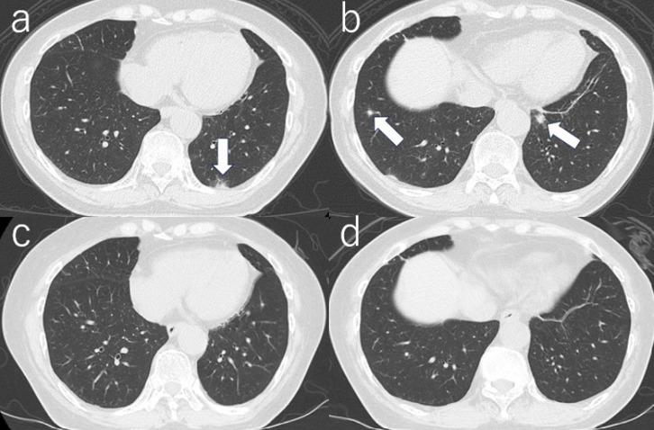 Maintaining complete response to avelumab for lung metastases from native ureteral cancer after kidney transplantation: a case report