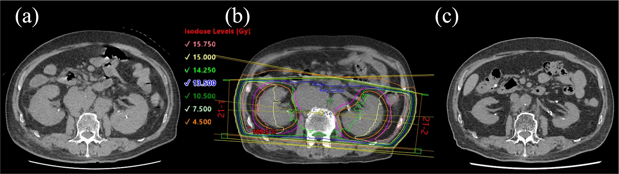 Palliative total kidney irradiation for acute kidney injury caused by bilateral renal infiltration of chemotherapy-resistant mantle cell lymphoma: a case report
