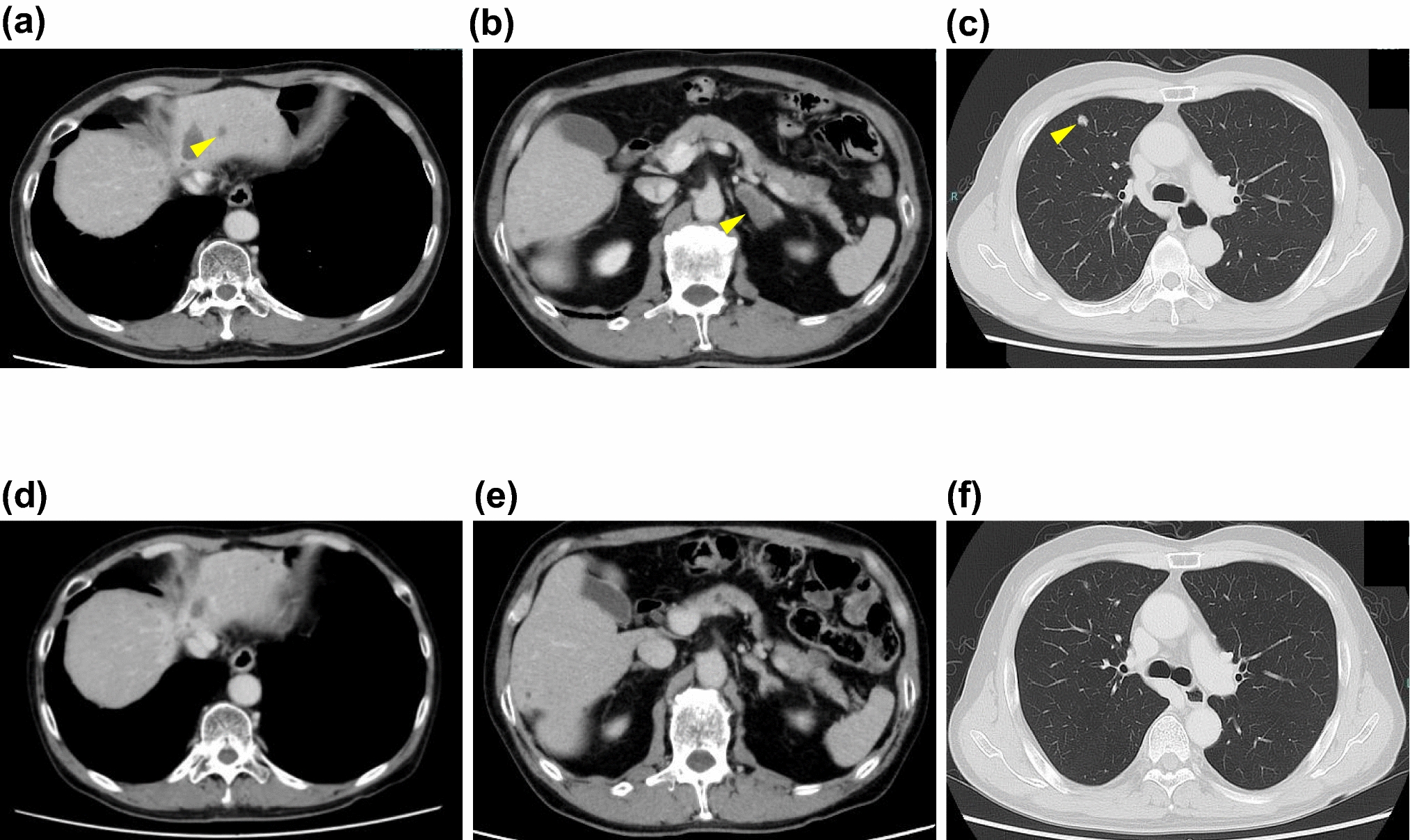 A case of advanced esophagogastric junction cancer in which comprehensive genomic profiling by liquid biopsy led to the diagnosis of a second primary hepatocellular carcinoma