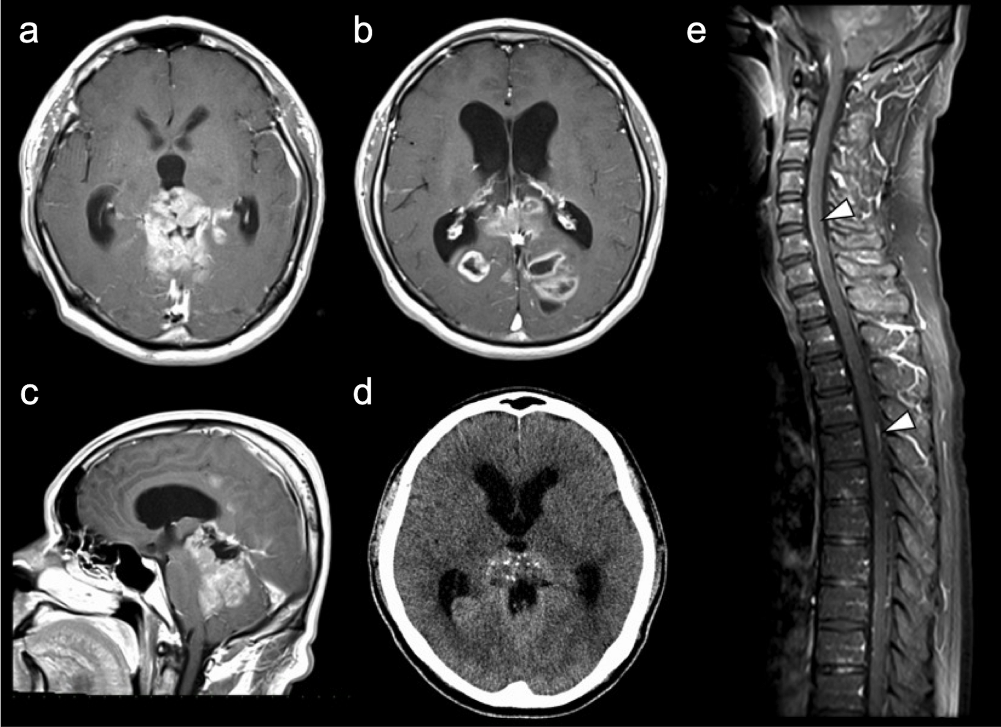 Combination of re-irradiation and bevacizumab for recurrent adult histological pineoblastoma: a case report