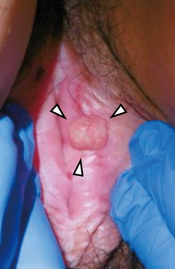 Pregnancy after fertility preservation and multimodal therapy including intensity-modulated radiotherapy for recurrent vulvar cancer: A case report