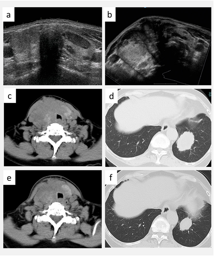 A case of poorly differentiated thyroid carcinoma harboring an  mutation