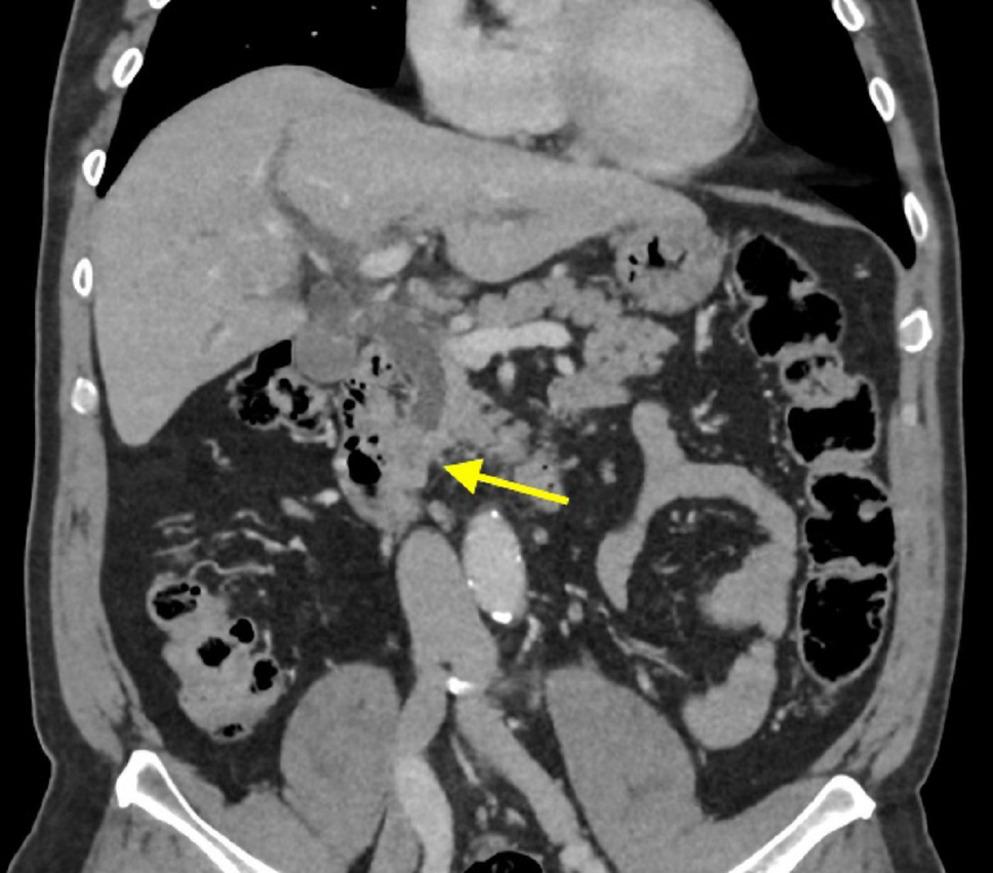 Sarcomatoid carcinoma of the common bile duct: A case report and review of the literature