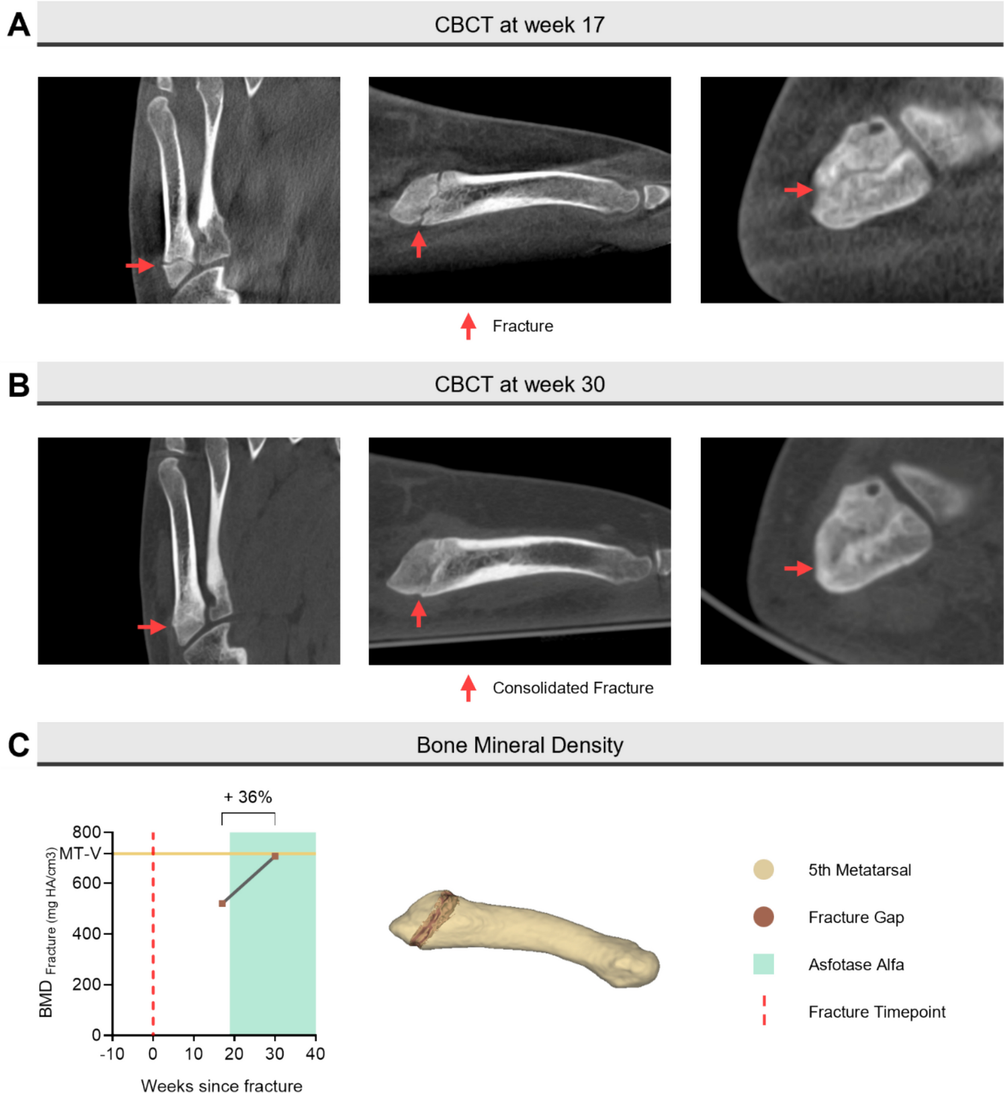 Successful treatment using asfotase alfa for delayed healing of a metatarsal stress fracture in an adolescent girl with hypophosphatasia